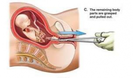 上环手术视频,专业视角下的操作步骤与注意事项